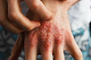 Nový kurz EUNI – Pruritus v dermatologii: Mechanismy, diagnostika a léčba