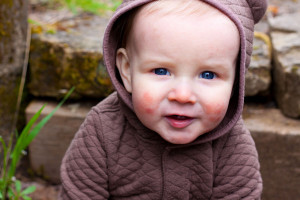 Účinnost a bezpečnost dupilumabu v reálné praxi u dětí s atopickou dermatitidou mladších 6 let