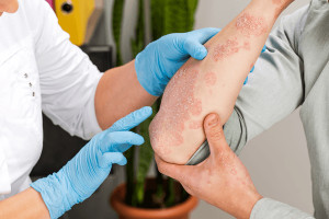 Protokol studie zaměřené na hodnocení farmakologické kondicionace jako strategie pro snížení dávky léčiva u pacientů s psoriázou
