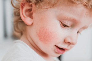 Dlouhodobá bezpečnost a účinnost léčby dupilumabem u dětí ve věku 6 měsíců až 5 let s těžkou atopickou dermatitidou