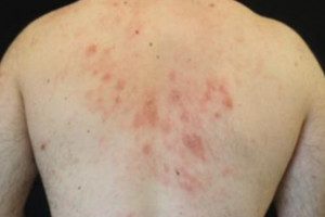 Hidradenitis suppurativa a atopická dermatitida: společné rysy zánětu typu 2 a zkušenost s dupilumabem